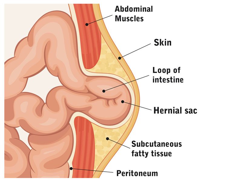 https://drdavidford.com/templates/yootheme/cache/a8/umbilical-hernia-diagram-a85914d9.jpeg