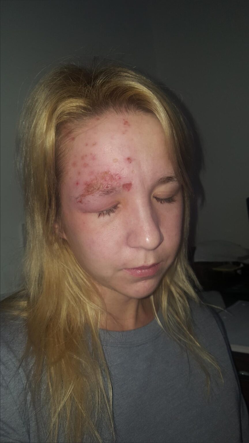 হার্পিস সিমপ্লেক্স (Herpes simplex) কি ভাবে প্রতিকার করা যায়? হার্পিস সিমপ্লেক্স (Herpes simplex) কি ভাবে প্রতিকার করা যায়?