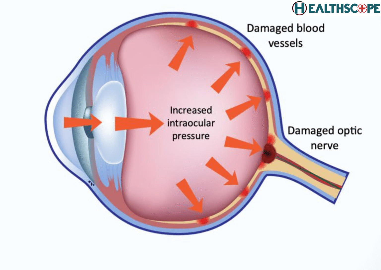 চোখের প্রেসার (Eye Pressure) বাড়লে কি করা উচিৎ? চোখের প্রেসার (Eye Pressure) বাড়লে কি করা উচিৎ?