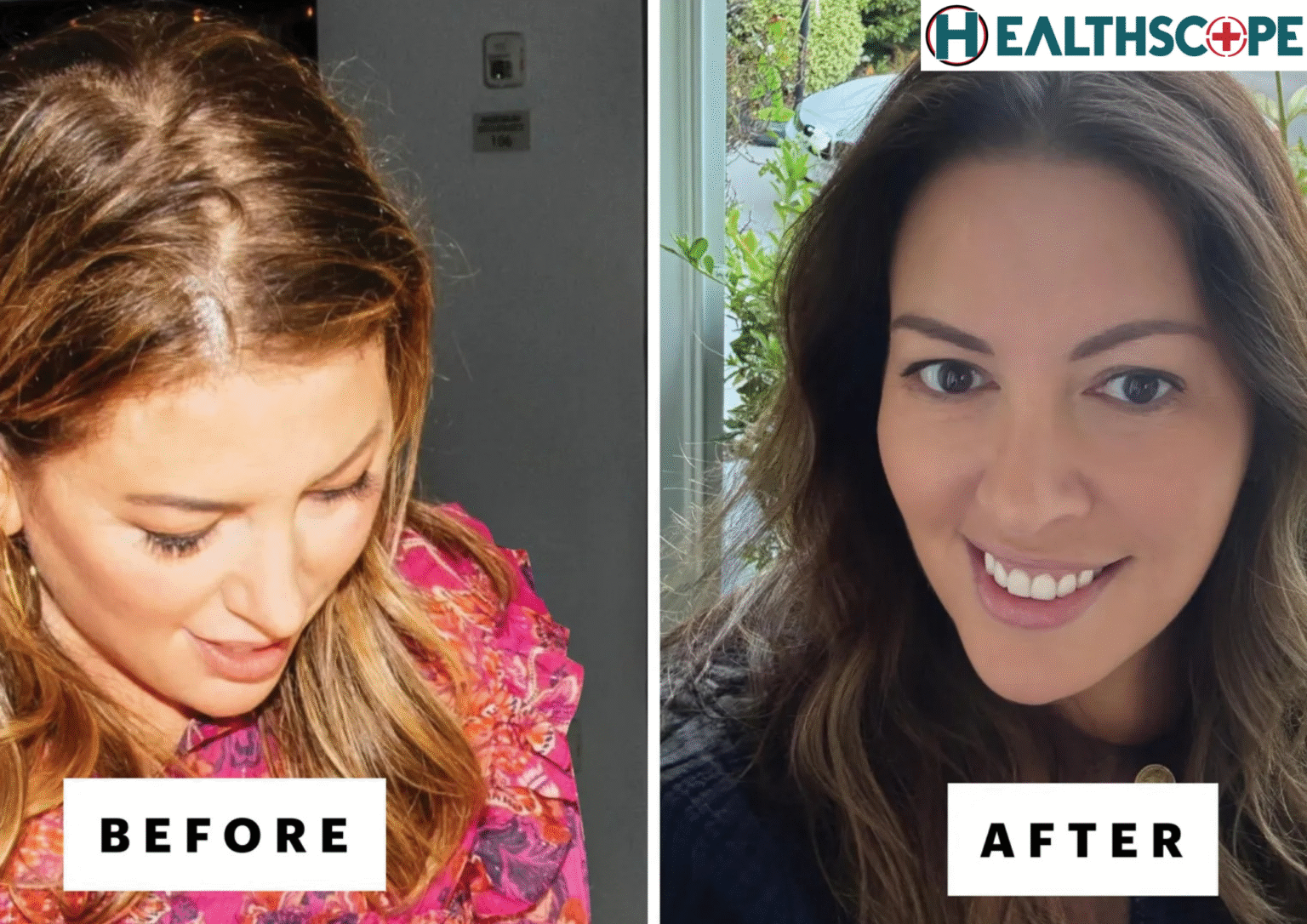 অকালে চুল ঝরে (Hair Loss) যাওয়া থেকে বাঁচতে কি করা উচিৎ? অকালে চুল ঝরে (Hair Loss) যাওয়া থেকে বাঁচতে কি করা উচিৎ?