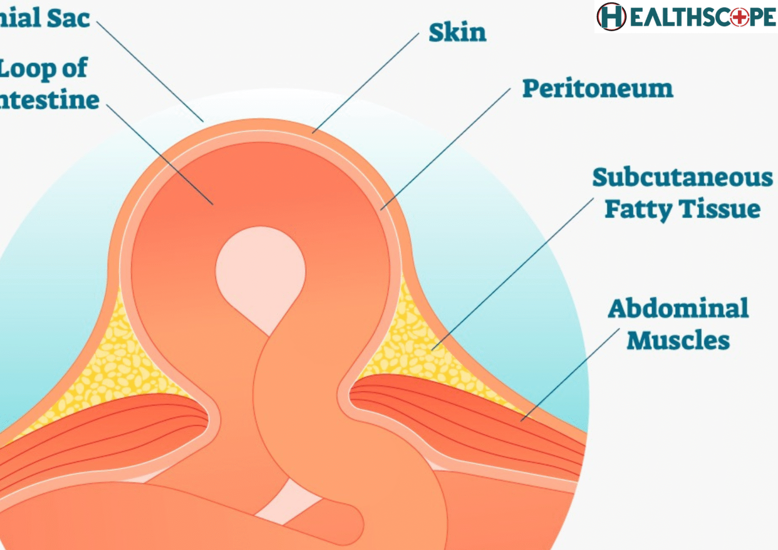 হার্নিয়া (Hernia) হওয়ার লক্ষণ ও তার প্রতিকার কি?