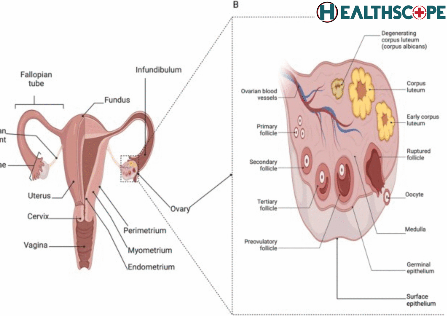 ওভারিতে টিউমার (Overian Tumor) হওয়ার লক্ষণ কি?