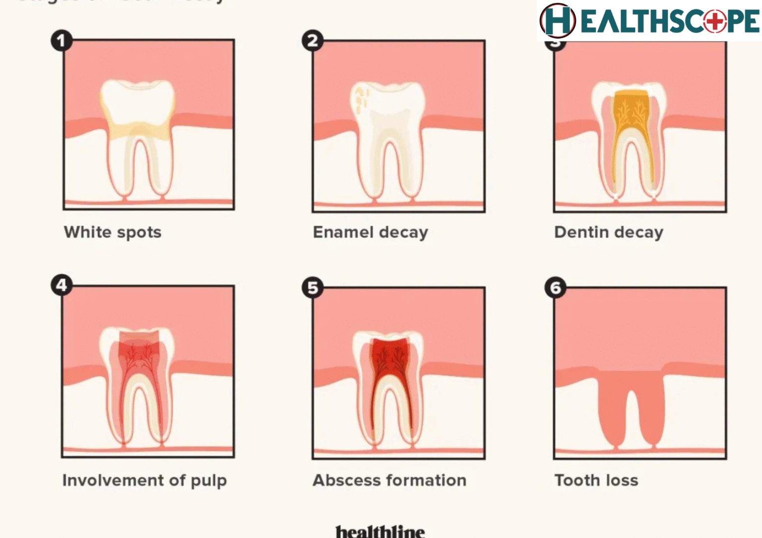 দাঁতের ক্ষয় (Tooth Decay) হওয়ার লক্ষণ কি?